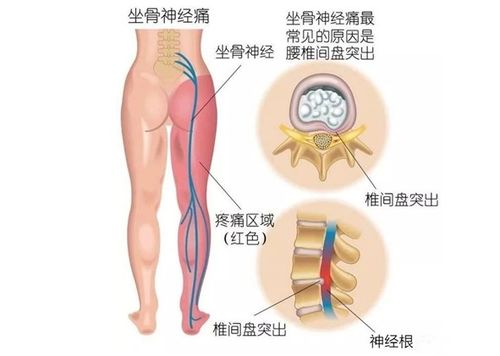 腰間盤突出做哪些鍛煉方法