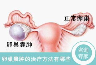 得了卵巢囊腫有哪些治療方法