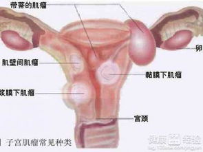常見的治療子宮肌瘤有哪些方法