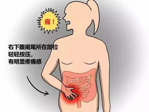 慢性盲腸炎會引起哪些不適療方法