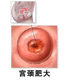 常見的治療宮頸肥大方法有哪些
