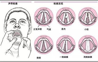 聲帶小結(jié)手術(shù)需不需要住院(需不需要作文)