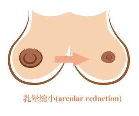 做乳暈變小手術(shù)注意事項(xiàng),乳暈注射注意事項(xiàng),激光乳暈?zāi)奂t術(shù)注意事項(xiàng)