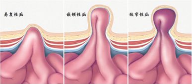 疝氣全麻手術(shù)后注意事項(xiàng)