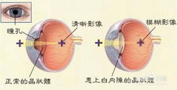 白內(nèi)障術(shù)后飲食注意事項