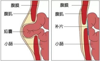 疝氣修補(bǔ)術(shù)后注意事項(xiàng)