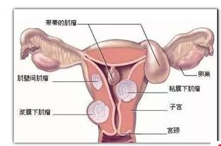 子宮肌瘤懷孕后注意事項(xiàng)