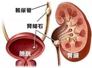 患有腎結(jié)石需注意事項