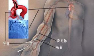 冠脈介入手術(shù)術(shù)后注意事項(xiàng),冠脈介入進(jìn)修匯報(bào)ppt,冠脈介入術(shù)前術(shù)后的注意事項(xiàng)