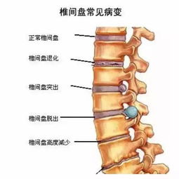 腰椎間盤小關(guān)節(jié)綜合癥注意事項(xiàng)