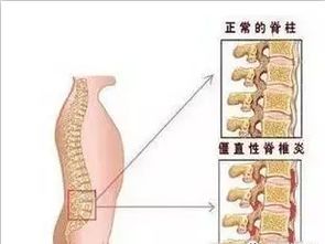 脊柱性關(guān)節(jié)炎注意事項(xiàng)