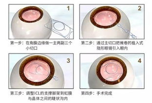 做高度近視手術術前注意事項