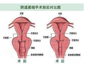 陰道緊縮術(shù)后注意事項(xiàng)