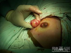 乳腺纖維瘤拆線后注意事項(xiàng),乳腺纖維瘤切除術(shù)后注意事項(xiàng),乳腺纖維瘤手術(shù)后注意事項(xiàng)及飲食