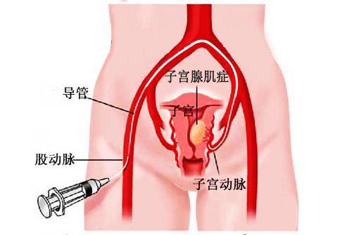 粘膜下子宮肌瘤宮腔鏡手術(shù)后多久可以恢復(fù),粘膜下子宮肌瘤宮腔鏡手術(shù)后十天還有血,粘膜下子宮肌瘤宮腔鏡手術(shù)后多久可以同房