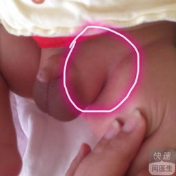 疝氣全麻手術(shù)后注意事項(xiàng),小孩疝氣手術(shù)后注意事項(xiàng)8大要點(diǎn)要謹(jǐn)記,腹腔鏡疝氣手術(shù)后注意事項(xiàng)