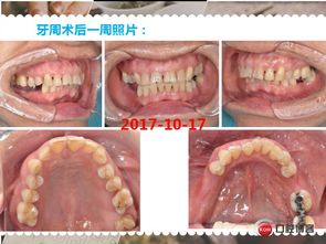 牙周病,書寫,注意事項
