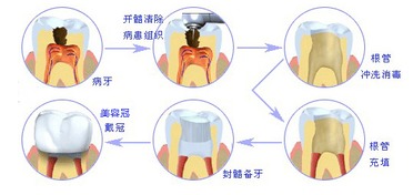 根管治療后有哪些注意事項(xiàng)