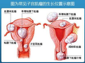 宮頸篩查注意事項(xiàng),宮頸疫苗注意事項(xiàng)和禁忌,宮頸疫苗打完注意事項(xiàng)