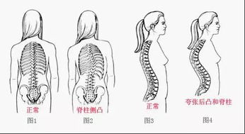 脊柱側(cè)彎懷孕注意事項(xiàng)