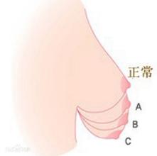 乳房下垂矯正后注意事項(xiàng)