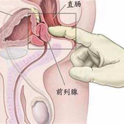 前列腺發(fā)炎注意事項(xiàng)
