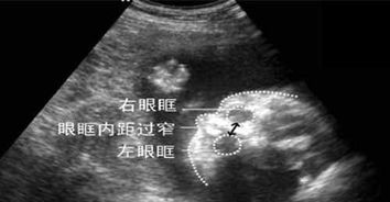 孕婦胎兒畸形幾個月引產(chǎn)注意事項