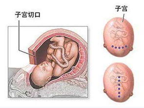 子宮破裂的注意事項(xiàng)