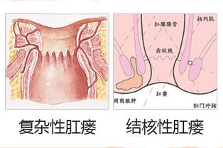 內瘺的術后護理及注意事項,動靜脈內瘺的護理與注意事項,肛瘺術后護理注意事項