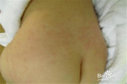 退燒后出疹子注意事項(xiàng),寶寶出疹子注意事項(xiàng),發(fā)燒出疹子注意事項(xiàng)