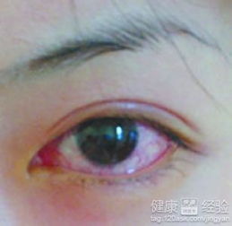 在線,結(jié)膜炎,大夫,注意事項