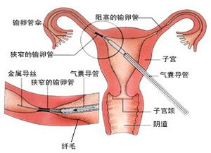 結(jié)扎復(fù)通術(shù)后注意事項(xiàng)