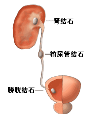 尿路結(jié)石術(shù)后注意事項有哪些,尿路結(jié)石插管術(shù)后注意事項,尿路結(jié)石微創(chuàng)手術(shù)后注意事項