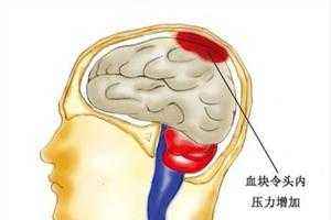 腦出血術(shù)后注意事項(xiàng)