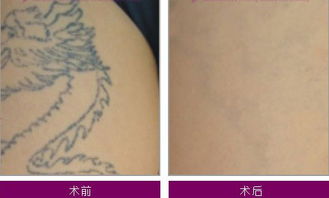 洗紋身術(shù)后注意事項(xiàng)