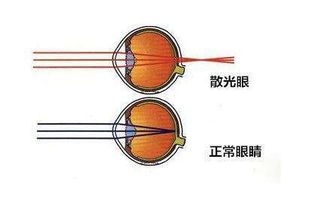 散光配眼鏡的注意事項(xiàng)