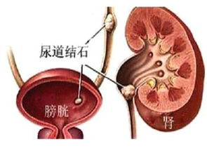 尿道結(jié)石術(shù)后注意事項(xiàng)