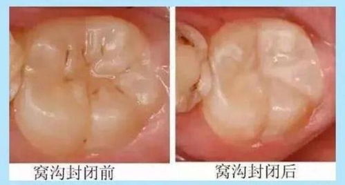 封閉牙齒后注意事項(xiàng)