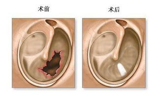 耳膜,修補,手術(shù)后,注意事項