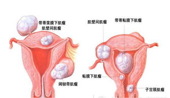 宮頸肌瘤術(shù)后注意事項(xiàng)