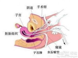引產(chǎn)后有什么注意事項(xiàng)嗎,引產(chǎn)前有什么注意事項(xiàng),引產(chǎn)后的注意事項(xiàng)和飲食調(diào)理