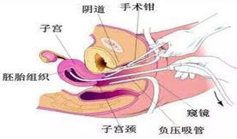 無痛人流流程和注意事項,無痛人流后注意事項,無痛人流當天注意事項