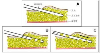 脂肪抽吸術(shù)后注意事項(xiàng)