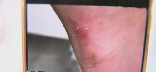 腳踝磕破縫針后注意事項(xiàng)