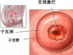 宮頸糜爛日常注意事項(xiàng),宮頸糜爛注意事項(xiàng)有哪些,微波治療宮頸糜爛后注意事項(xiàng)