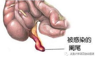 闌尾炎,開刀,注意事項(xiàng)