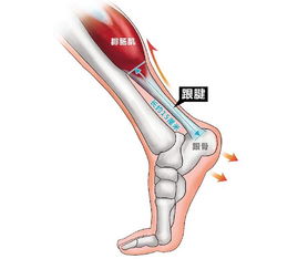 跟腱斷裂手術前后注意事項