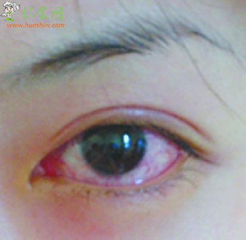 結(jié)膜裂傷注意事項(xiàng),結(jié)膜下出血注意事項(xiàng),球結(jié)膜注射的注意事項(xiàng)