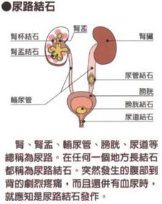 尿路結(jié)石術(shù)后注意事項