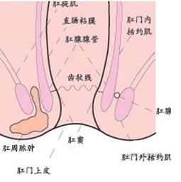 肛瘺確診前注意事項(xiàng)